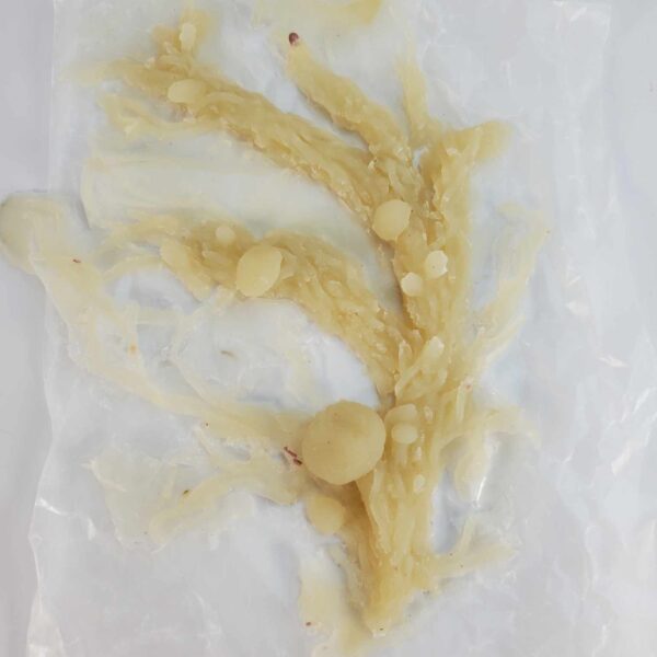 Silicone Prosthetic Fungal Varicose Vine